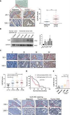 IL25 Enhanced Colitis-Associated Tumorigenesis in Mice by Upregulating Transcription Factor GLI1